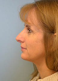 Rhinoplasty Before and After Pictures Philadelphia, PA