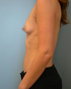 Breast Augmentation Before and After Pictures Philadelphia, PA