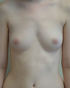 Breast Augmentation Before and After Pictures Philadelphia, PA