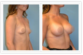 Breast Augmentation Before and After Pictures Philadelphia, PA