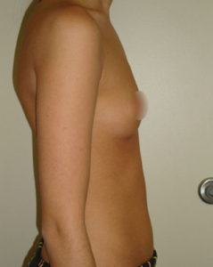 Breast Augmentation Before and After Pictures Philadelphia, PA