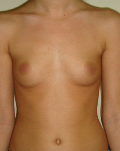 Breast Augmentation Before and After Pictures Philadelphia, PA