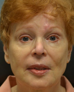 Skin Cancer Reconstruction Brow Lift Before and After Pictures Philadelphia, PA