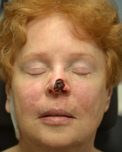 Skin Cancer Reconstruction Brow Lift Before and After Pictures Philadelphia, PA