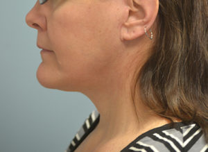 Facelift Before and After Pictures in Philadelphia, PA