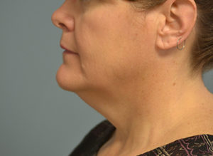 Facelift Before and After Pictures in Philadelphia, PA