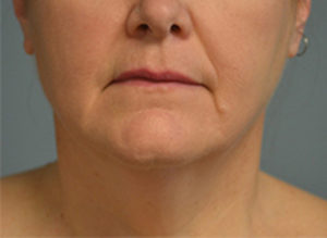 Facelift Before and After Pictures in Philadelphia, PA