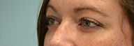 Eyelid Surgery Before and After Pictures Philadelphia, PA