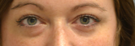 Eyelid Surgery Before and After Pictures Philadelphia, PA