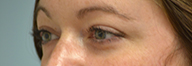 Eyelid Surgery Before and After Pictures Philadelphia, PA