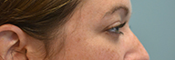 Eyelid Surgery Before and After Pictures Philadelphia, PA