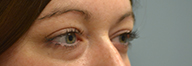 Eyelid Surgery Before and After Pictures Philadelphia, PA