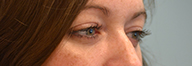 Eyelid Surgery Before and After Pictures Philadelphia, PA