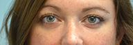 Eyelid Surgery Before and After Pictures Philadelphia, PA