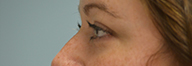 Eyelid Surgery Before and After Pictures Philadelphia, PA