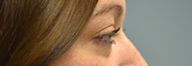 Eyelid Surgery Before and After Pictures Philadelphia, PA