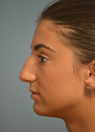 Rhinoplasty Before and After Pictures Philadelphia, PA