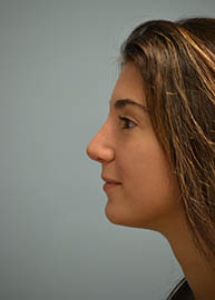 Rhinoplasty Before and After Pictures Philadelphia, PA