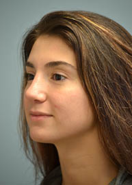 Rhinoplasty Before and After Pictures Philadelphia, PA