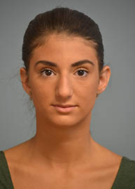 Rhinoplasty Before and After Pictures Philadelphia, PA