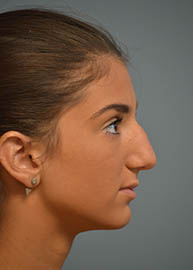 Rhinoplasty Before and After Pictures Philadelphia, PA