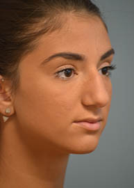 Rhinoplasty Before and After Pictures Philadelphia, PA