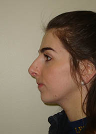 Rhinoplasty Before and After Pictures Philadelphia, PA