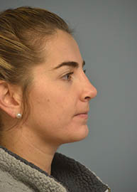 Rhinoplasty Before and After Pictures Philadelphia, PA