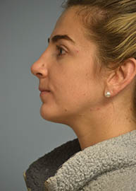 Rhinoplasty Before and After Pictures Philadelphia, PA