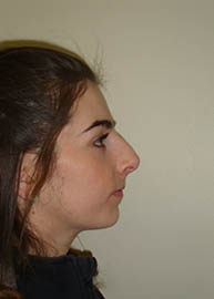 Rhinoplasty Before and After Pictures Philadelphia, PA