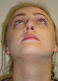 Rhinoplasty Before and After Pictures Philadelphia, PA