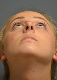 Rhinoplasty Before and After Pictures Philadelphia, PA