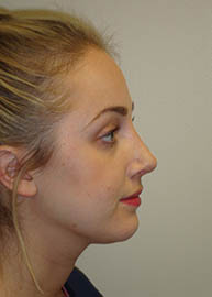 Rhinoplasty Before and After Pictures Philadelphia, PA