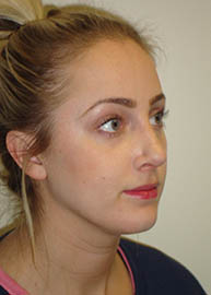 Rhinoplasty Before and After Pictures Philadelphia, PA