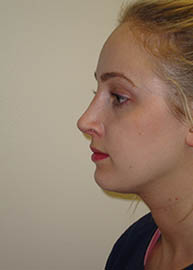 Rhinoplasty Before and After Pictures Philadelphia, PA