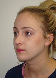 Rhinoplasty Before and After Pictures Philadelphia, PA