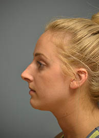 Rhinoplasty Before and After Pictures Philadelphia, PA