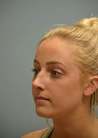 Rhinoplasty Before and After Pictures Philadelphia, PA