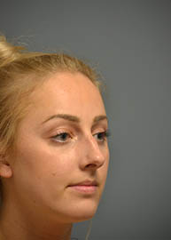 Rhinoplasty Before and After Pictures Philadelphia, PA