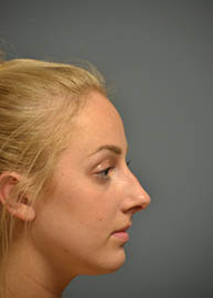 Rhinoplasty Before and After Pictures Philadelphia, PA