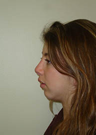 Rhinoplasty Before and After Pictures Philadelphia, PA