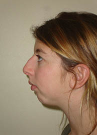 Rhinoplasty Before and After Pictures Philadelphia, PA