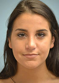 Rhinoplasty Before and After Pictures Philadelphia, PA