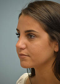 Rhinoplasty Before and After Pictures Philadelphia, PA