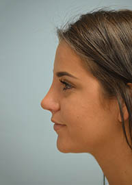 Rhinoplasty Before and After Pictures Philadelphia, PA