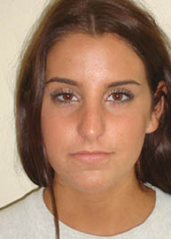 Rhinoplasty Before and After Pictures Philadelphia, PA