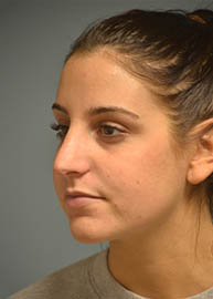 Rhinoplasty Before and After Pictures Philadelphia, PA