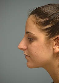 Rhinoplasty Before and After Pictures Philadelphia, PA