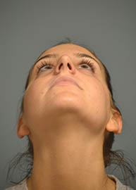 Rhinoplasty Before and After Pictures Philadelphia, PA