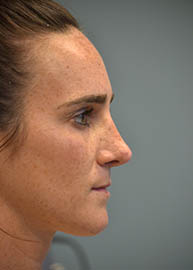 Rhinoplasty Before and After Pictures Philadelphia, PA